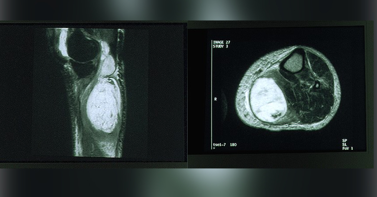 Diagnose The Patient With Cystic Mass In Left Calf