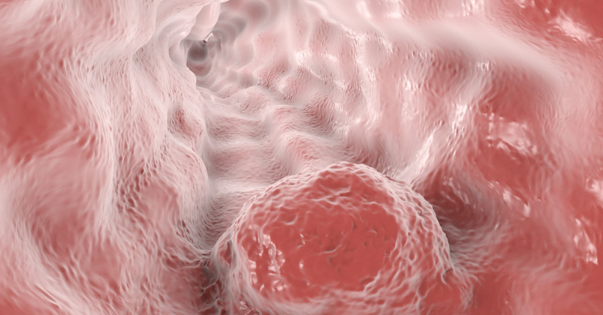 Surprisingly Aspirin Causing Gastritis With PPI Prevent Cancer In Barrett's Oesophagus