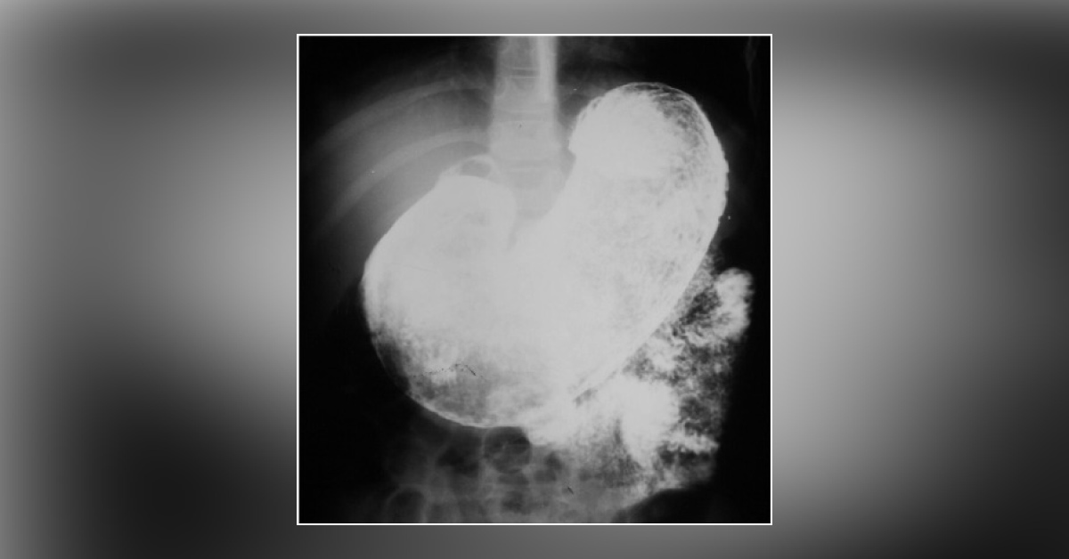 A Case Of Mentally Challenged Teenager With Bloating
