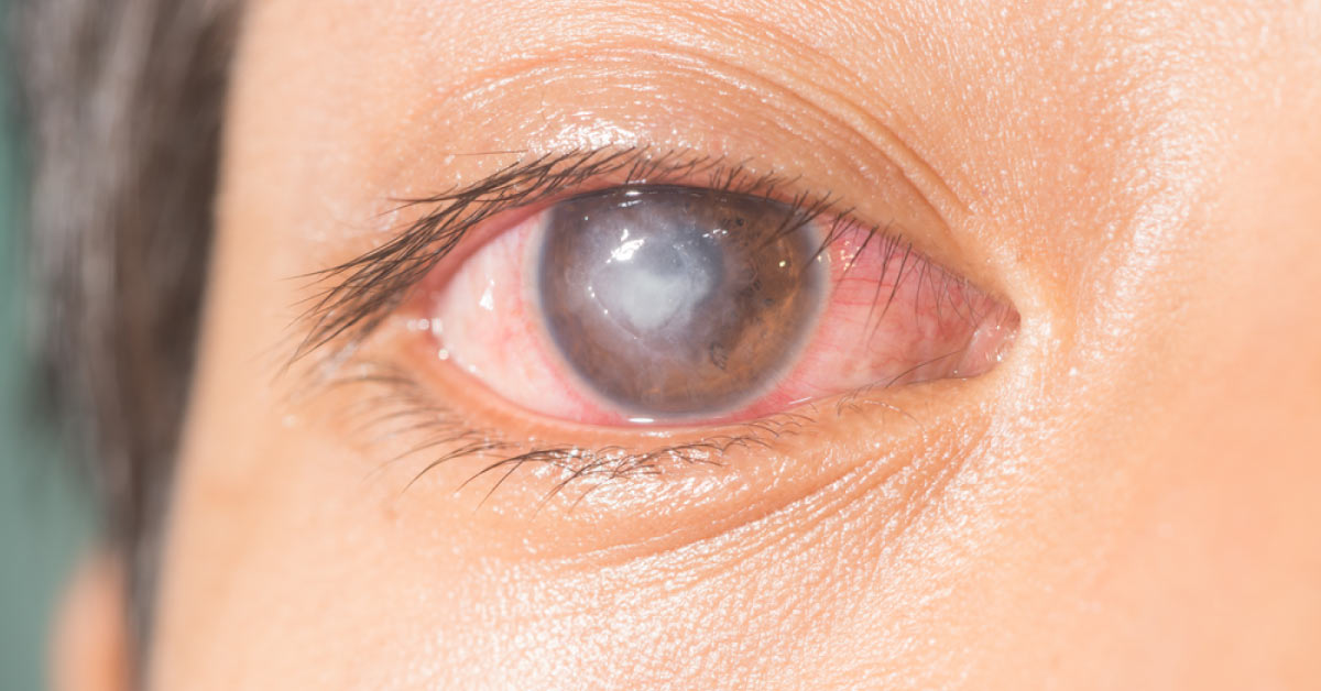 The Old Pattern Classification Of Corneal Dystrophy
