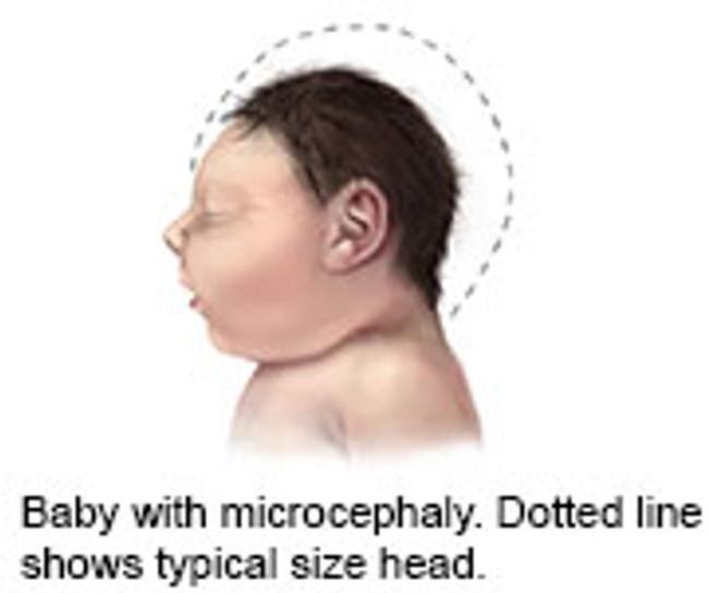 Scans Show Range Of Zika-Linked Infant Brain Defects