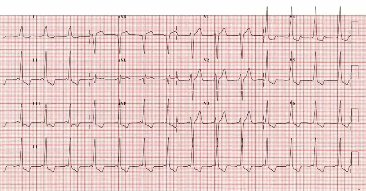 Interpret the ECG