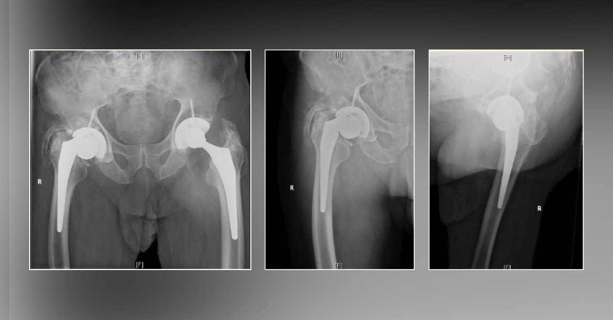 Pain and Cracking Sensation in the Right Hip