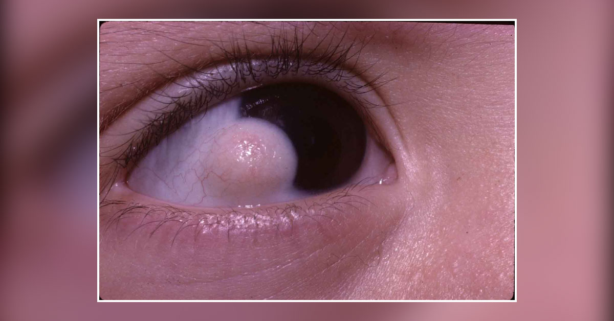 Brief Review On Complications Of Dermolipoma Surgery