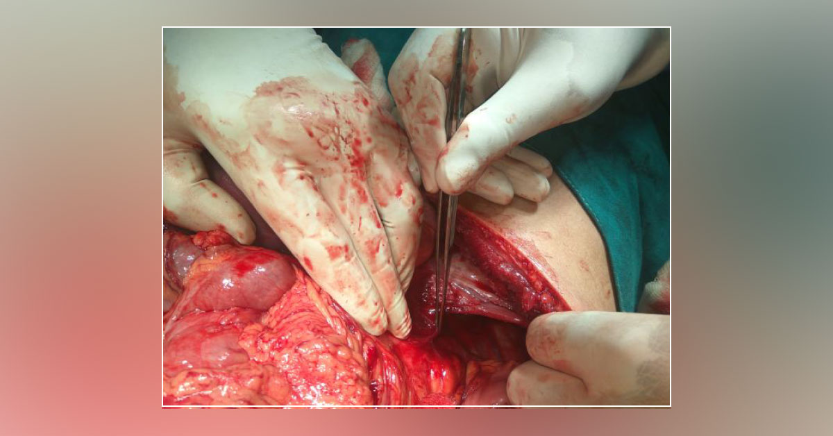Effective Material Developed To Prevent Post-Surgical Adhesion