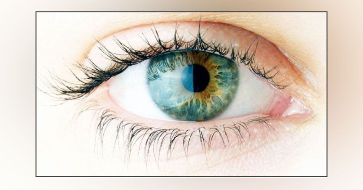 Glaucoma May Be An Autoimmune Disease