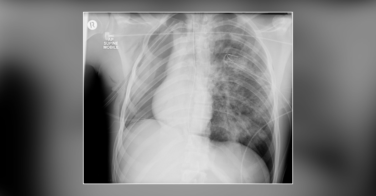 Patient With Motor Road Accident