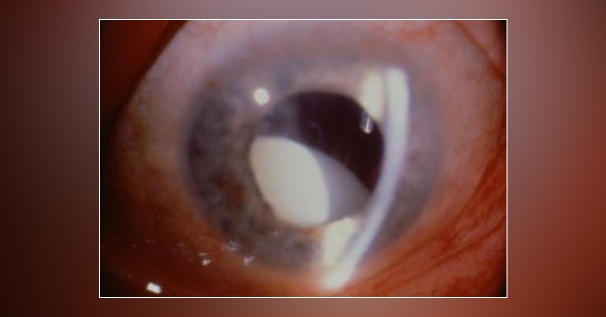 Causes Of Lens Dislocation