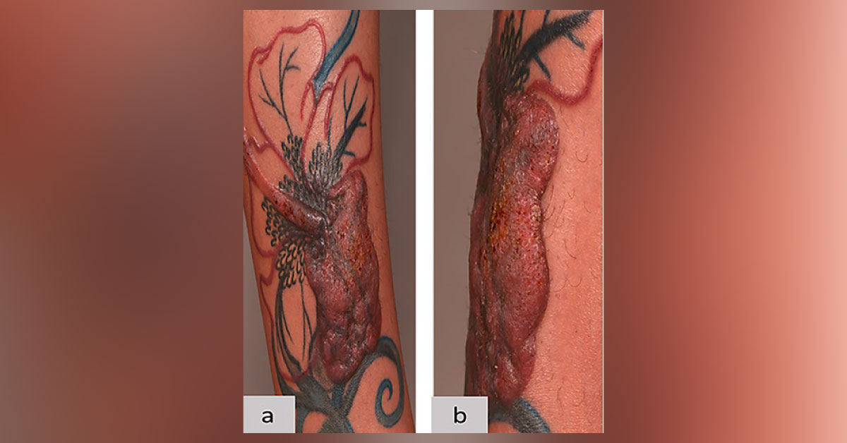 Can You Identify This Tattoo-related Complication?