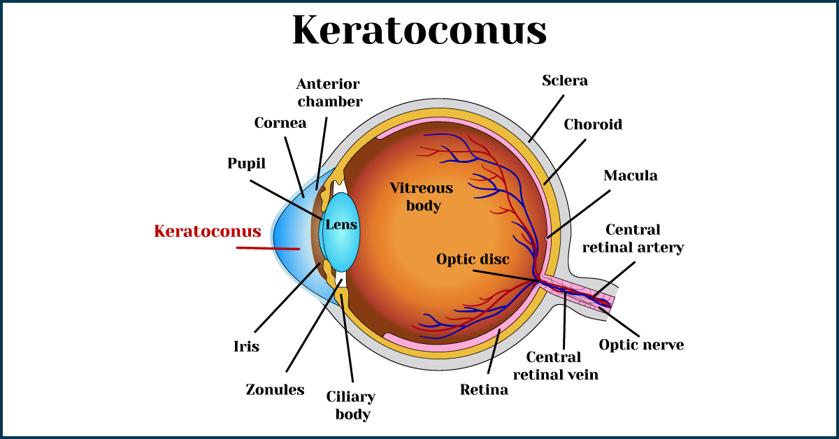Various Conditions Associated With Keratoconus