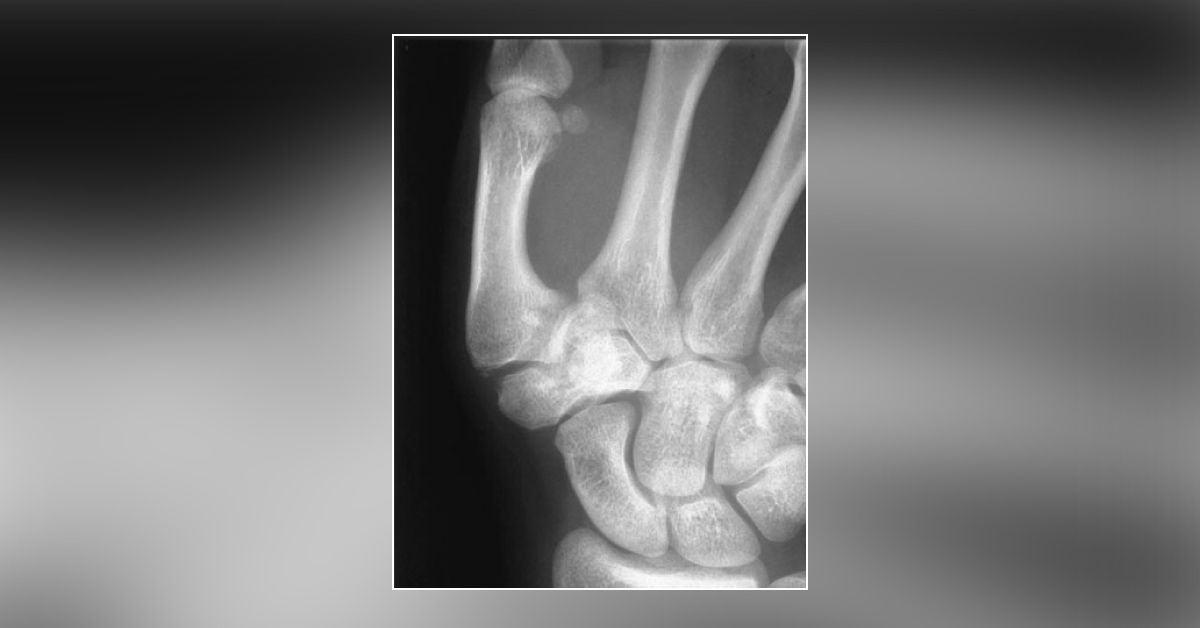 Case of a Man with Painful Thumb Following a Fall