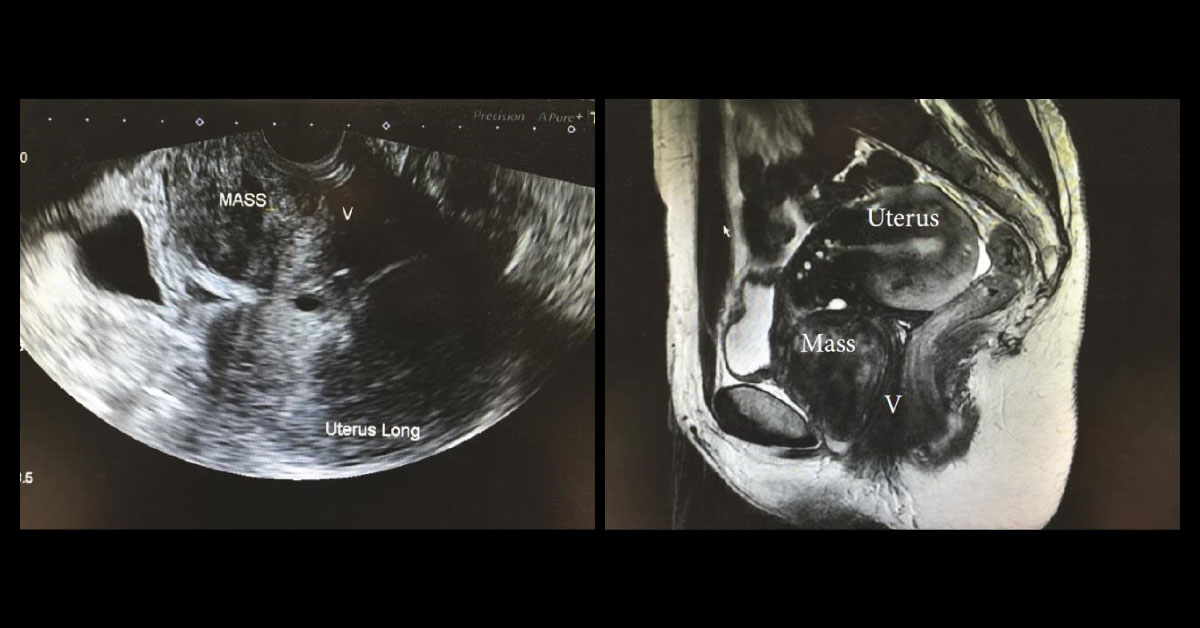 Case Of Acute Episode Of Pelvic Pain