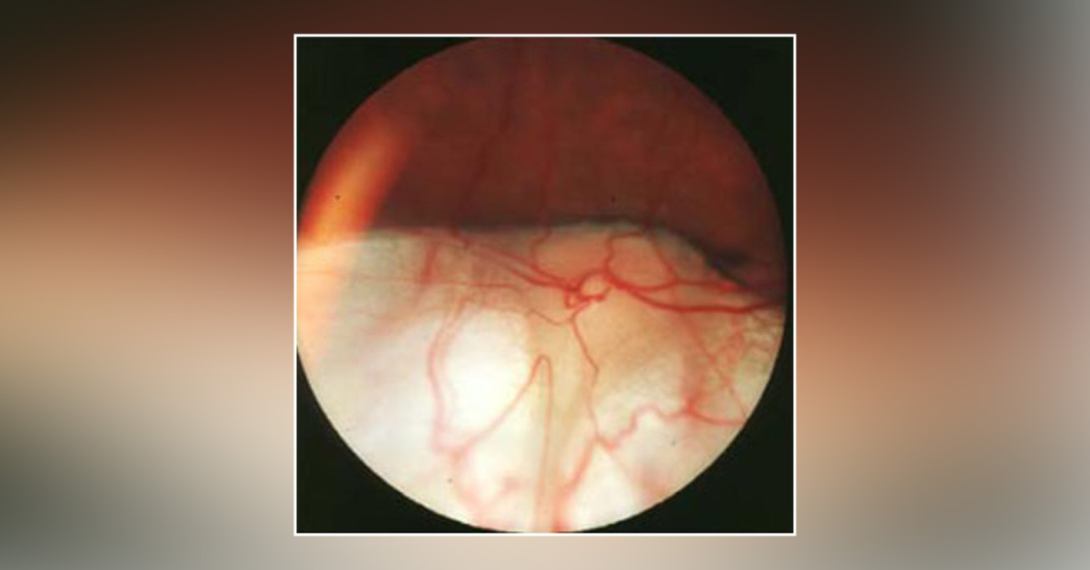 Enlist The Congenital Eye Conditions