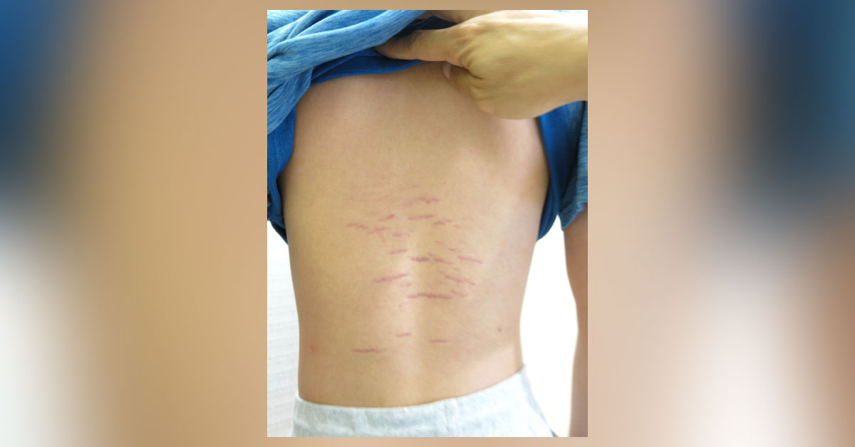 Case Of Asymptomatic Rashes