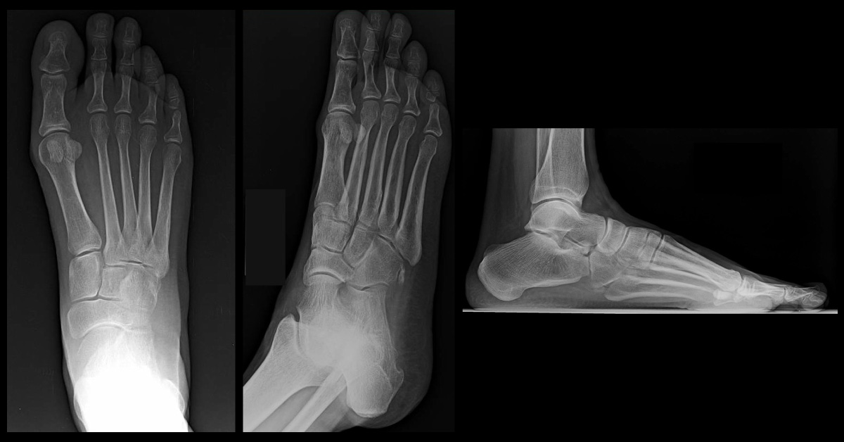 Female With Acute Foot Pain