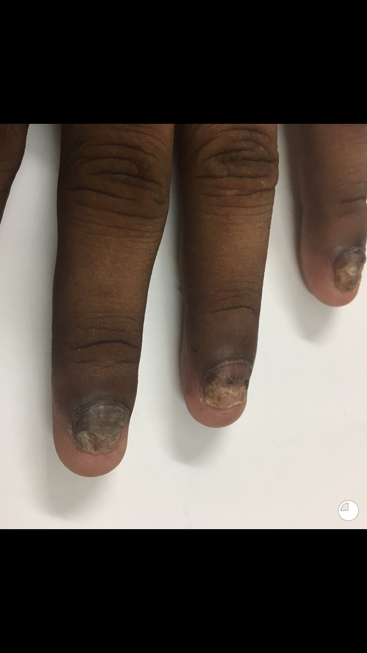 Diagnose The Deformed Nails