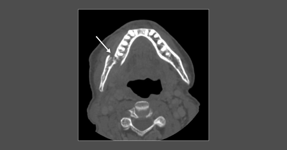 57-year-old with Jaw Pain