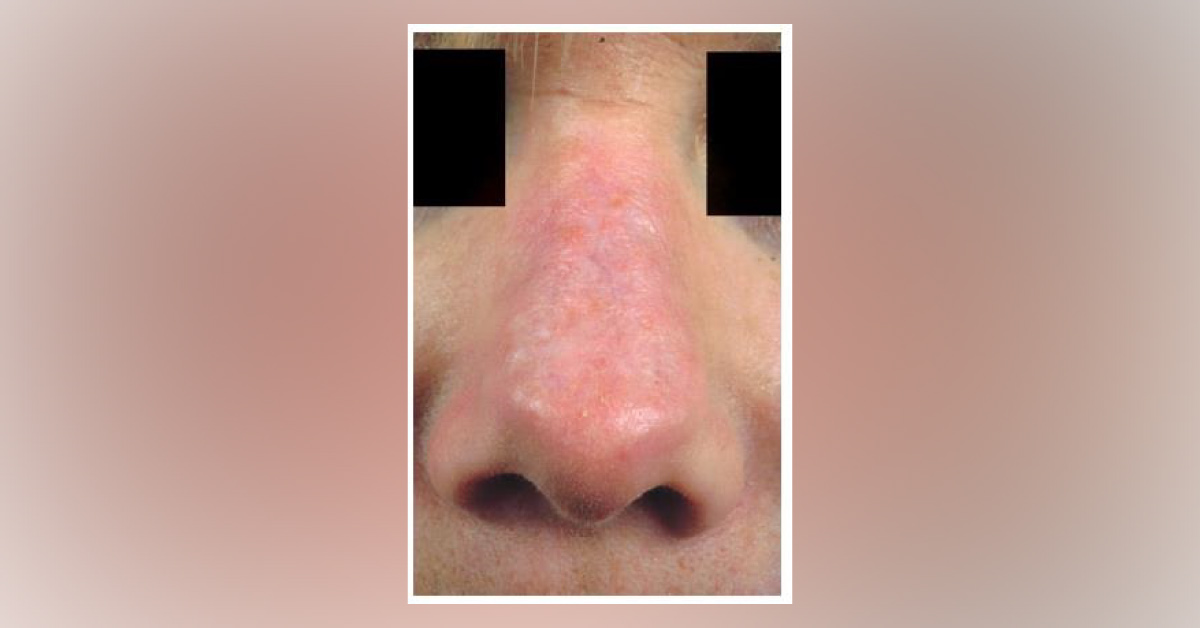 A Case Of Skin Pain In A Child
