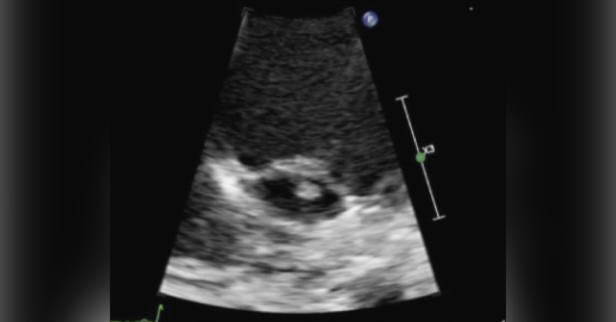 Identify This Uncommon Infection in a Pediatric Patient