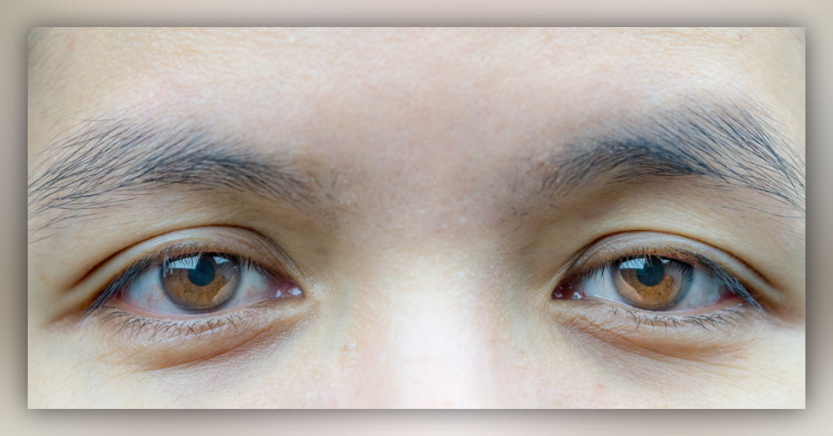 Brief Review On Lids Ptosis