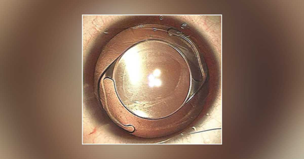 Recent Surgical Modalities of PC IOL