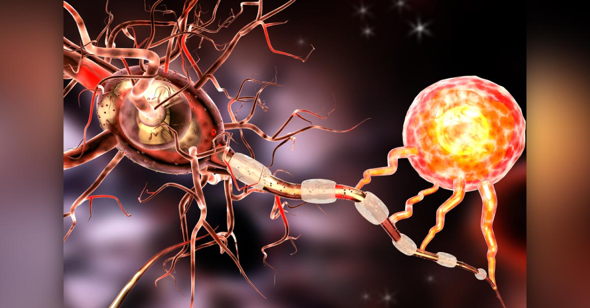Diagnosis Of Multiple Sclerosis