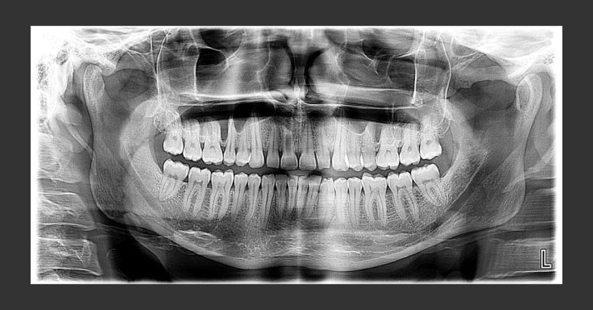 Case Of Pain Below Left Temporomandibular Joint Disorders (TMJ)