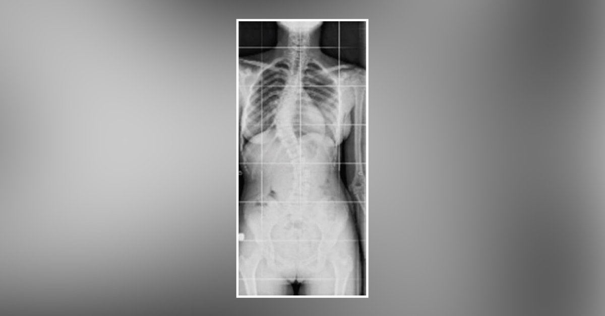 Case of a Young Female with Stooped Right Shoulder