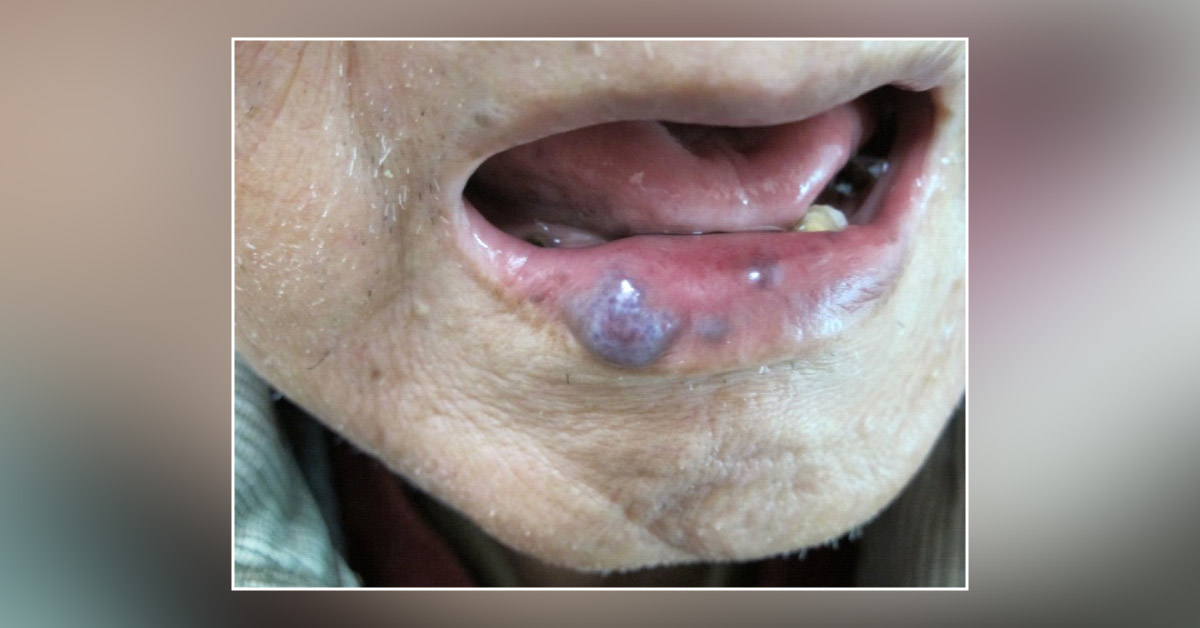 Nodules on the Lower Lip
