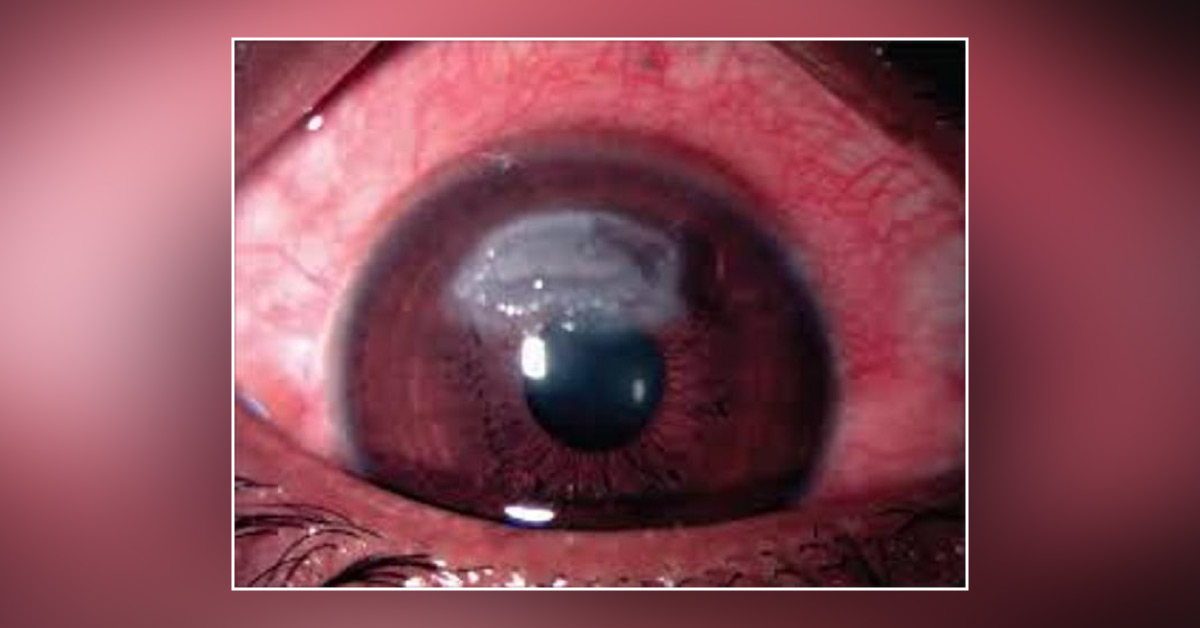 Brief Review On Shield Or Vernal Ulcer