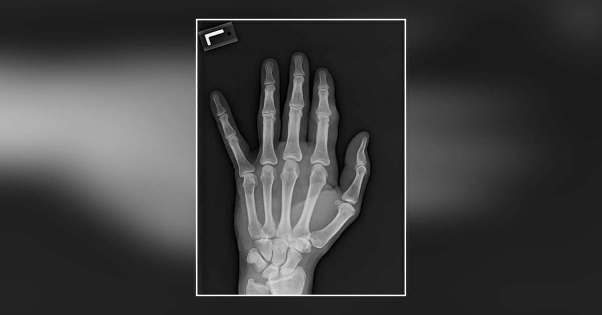 Abrupt Onset Index PIP Swelling