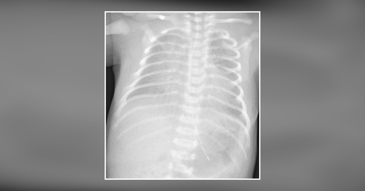 What is Evident from the Baby’s X-ray?