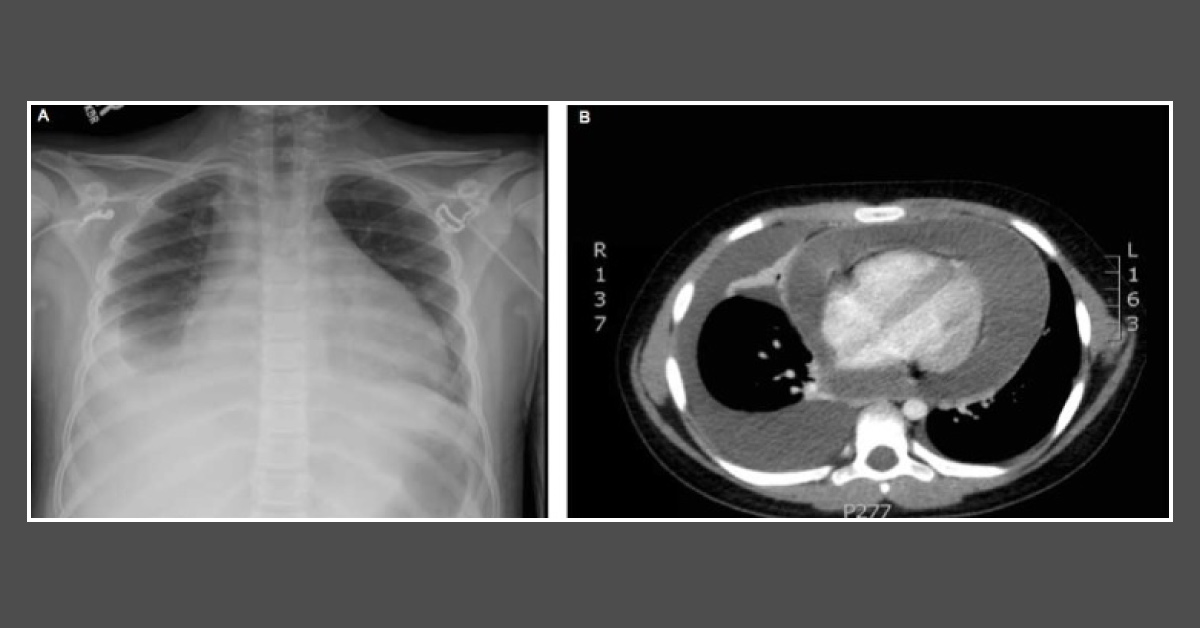 Diagnose This Boy With Recurrent Fever And Persistent Infection