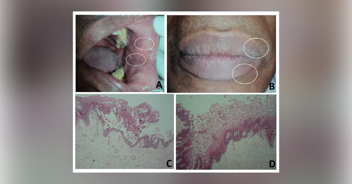 White Lesions on Buccal Mucosa: What is Your Diagnosis?