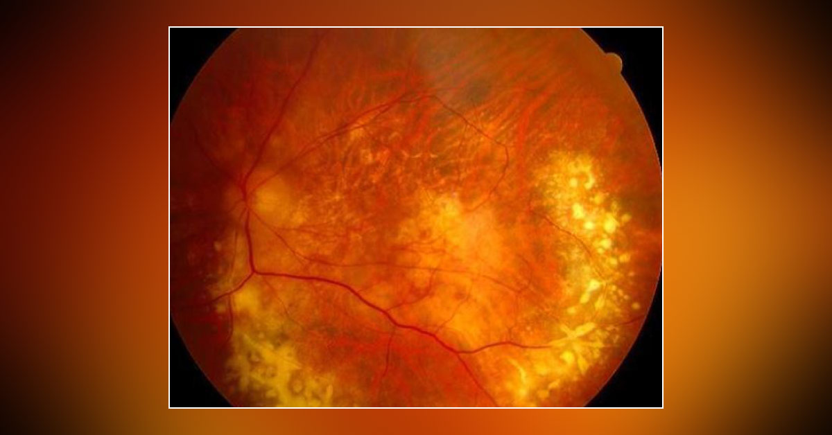 Spot The Diagnosis Of Given Ophthalmic Condition