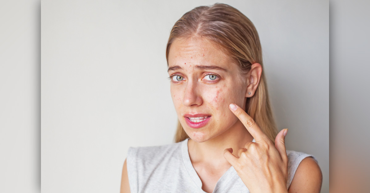 A Vaccine Is On The Way To Control And Prevent Acne