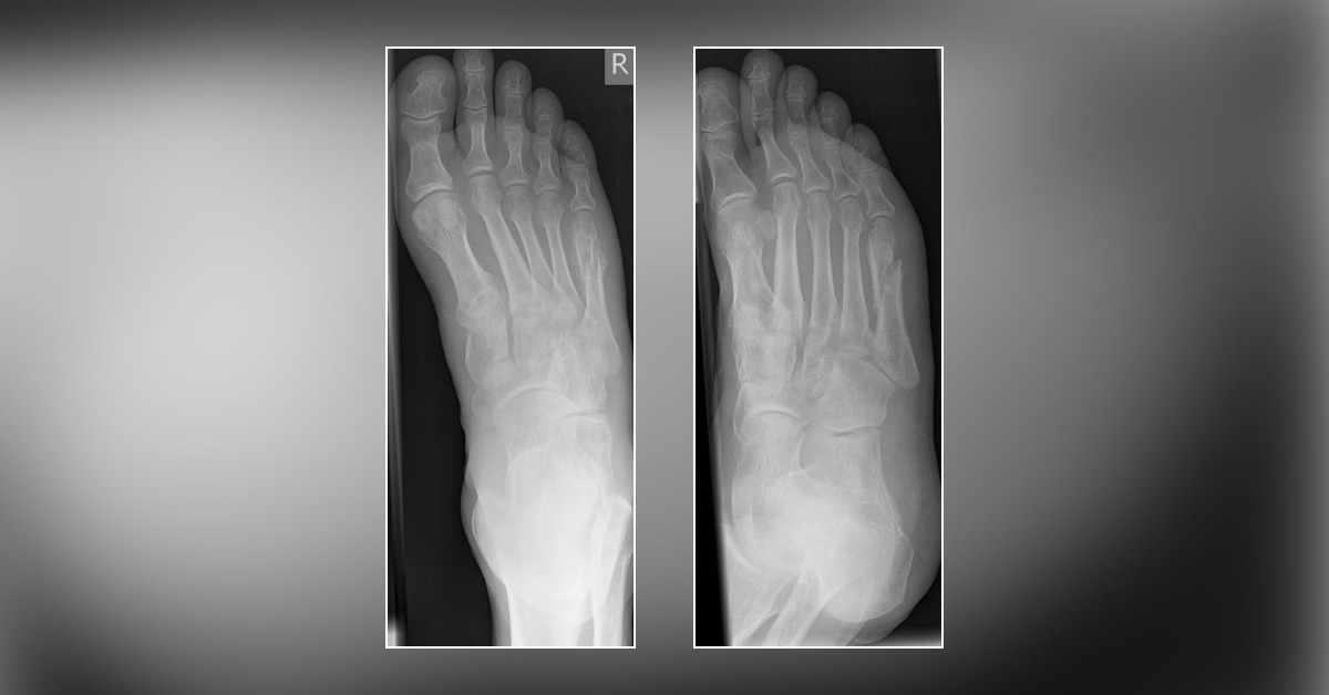 Which Metatarsal Bone Fracture Is This?