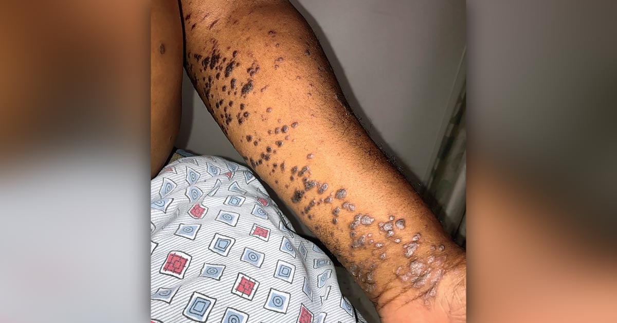 Pruritic Rashes Following HCV Treatment