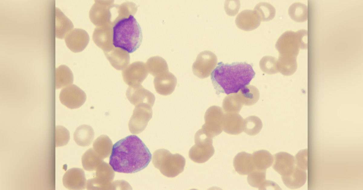 Acute Lymphoblastic Leukaemia: Frequently Asked Questions