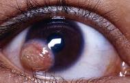 Brief Review On The Treatment Of Limbal Dermoid