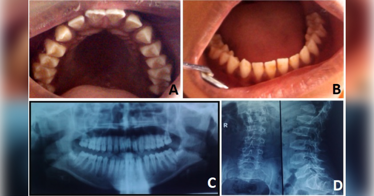 Can You Identify This Debilitating Disorder?