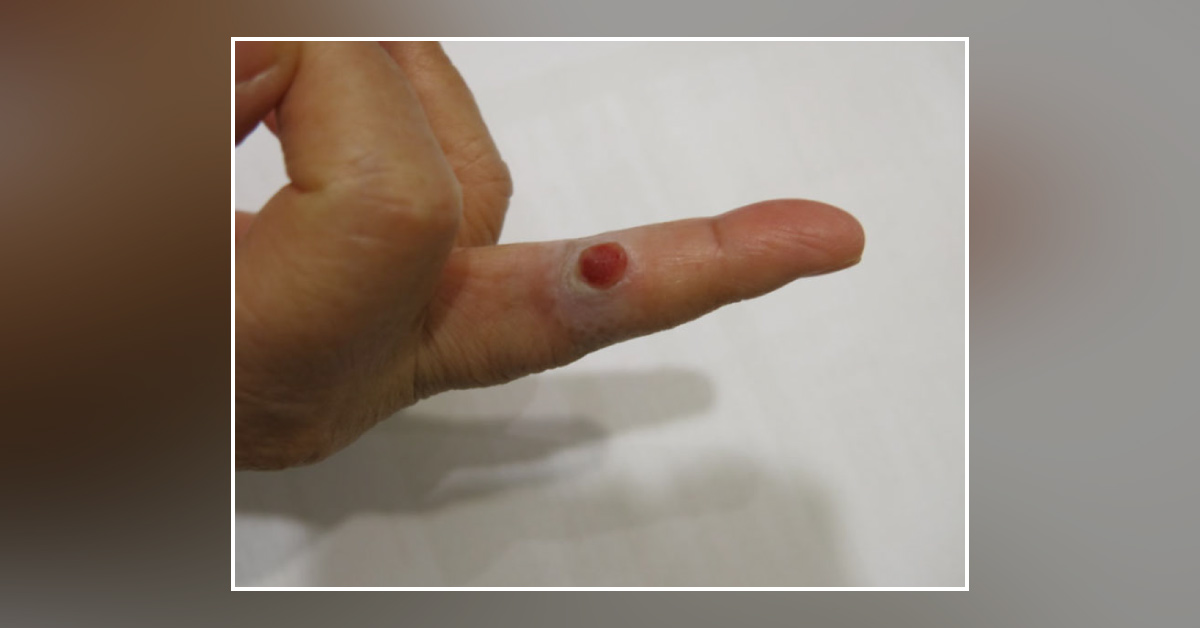 Reddish Nodule Over Right Middle Finger