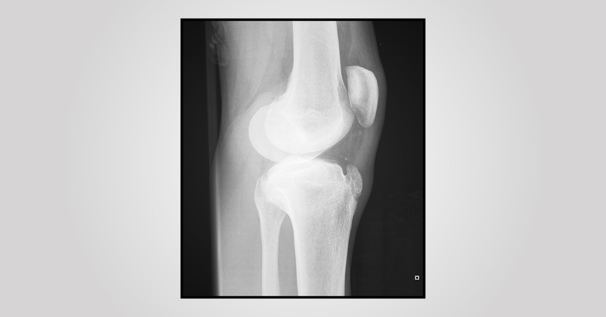 Diagnose The Soccer Player’s Pain?