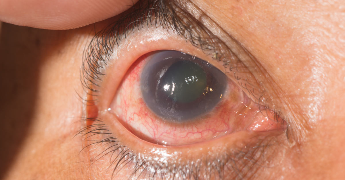Could Glaucoma Be An Autoimmune Disease?