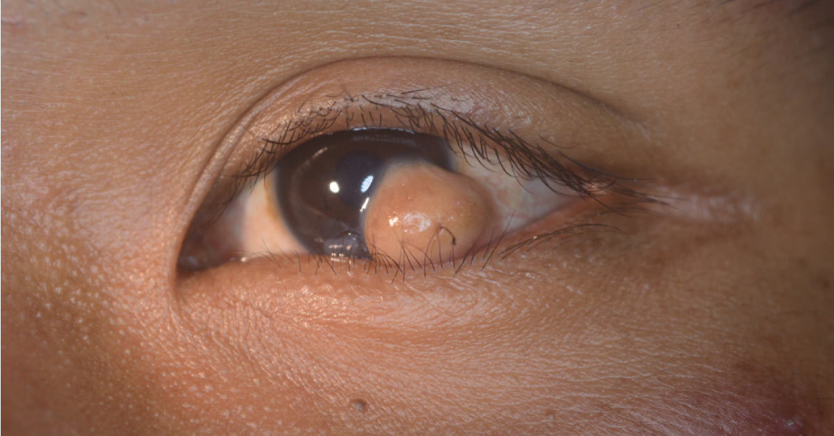 Surgical Treatment Of Limbal Dermoid