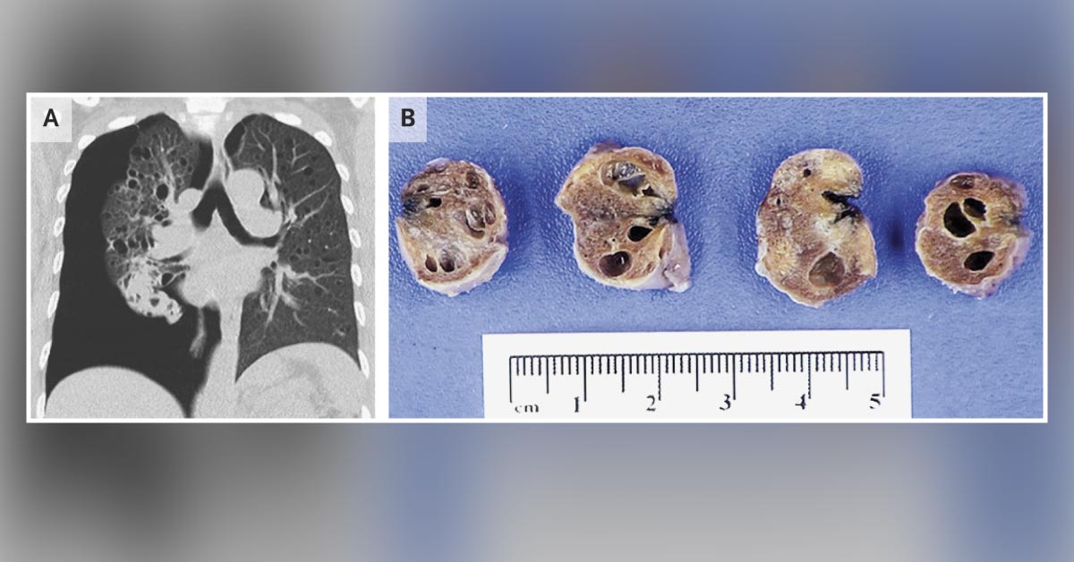 A Woman With Chest Pain and Dyspnea