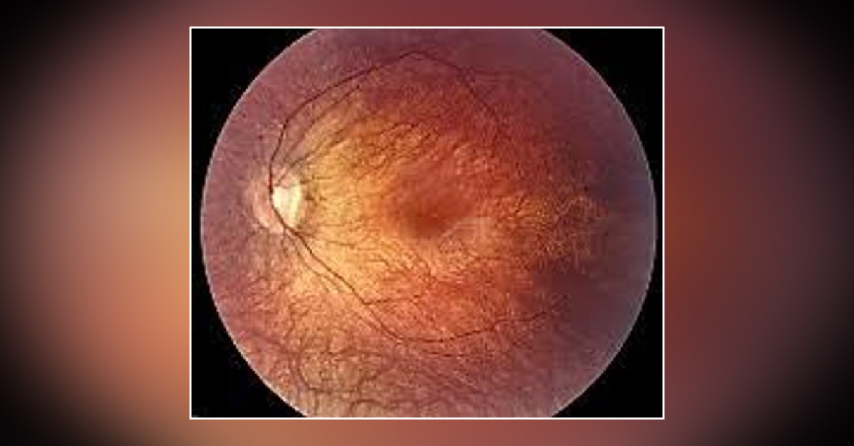 Brief Scenario On Retinitis Pigmentosa And Its Various Associations