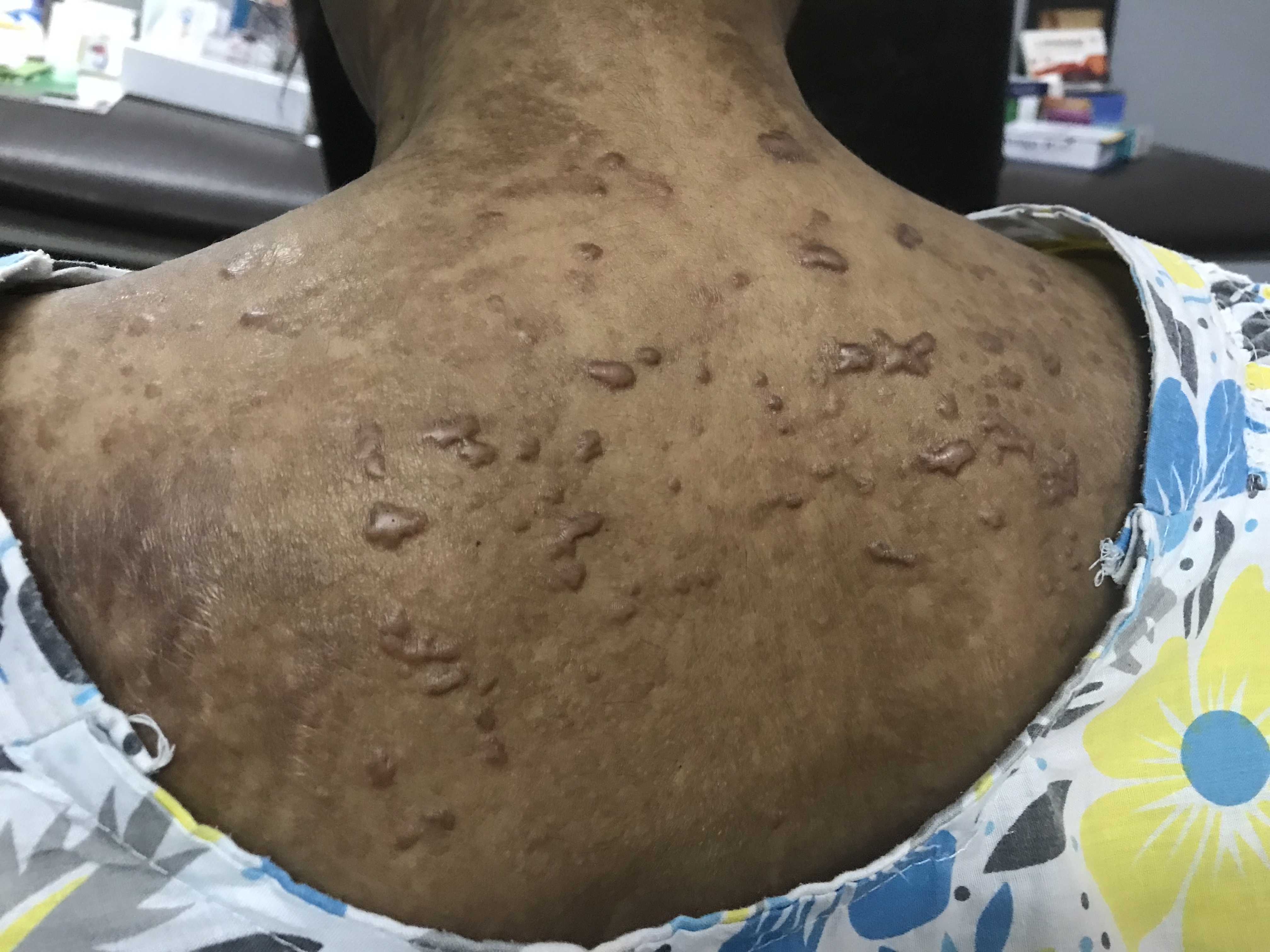 Chemotherapy Induced Keloids, How To Treat?