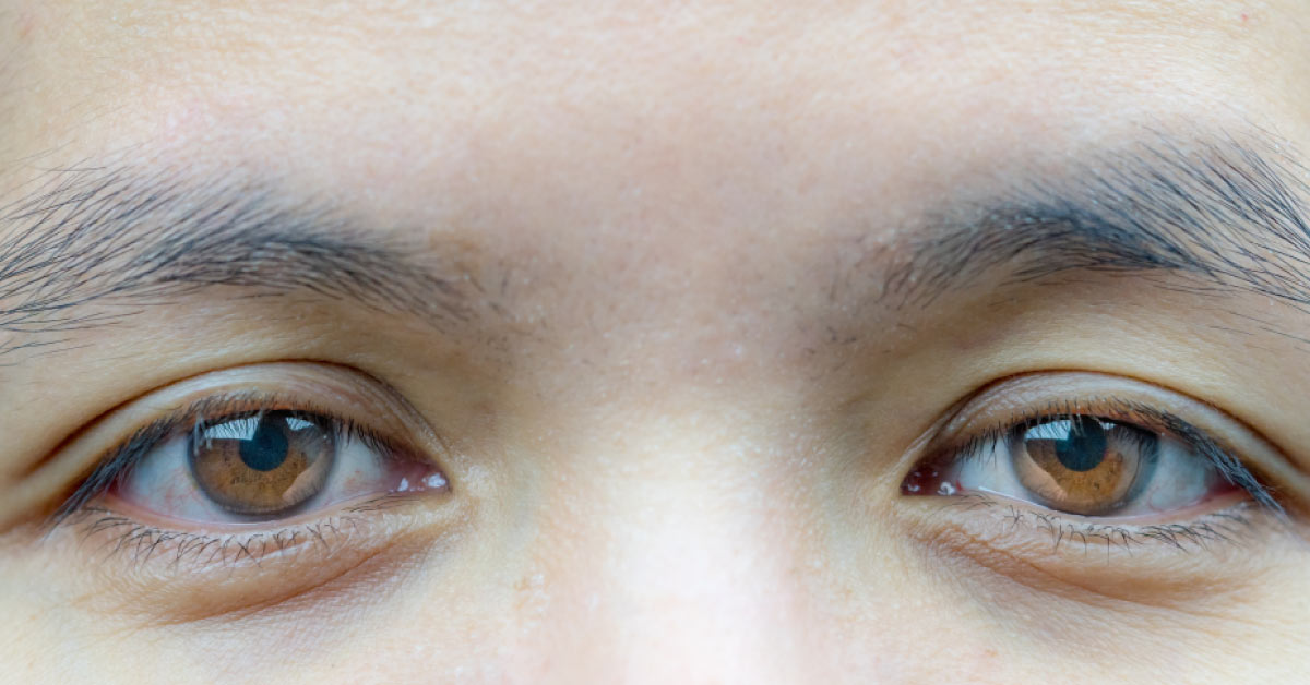 Brief Review On Classification Of Ptosis