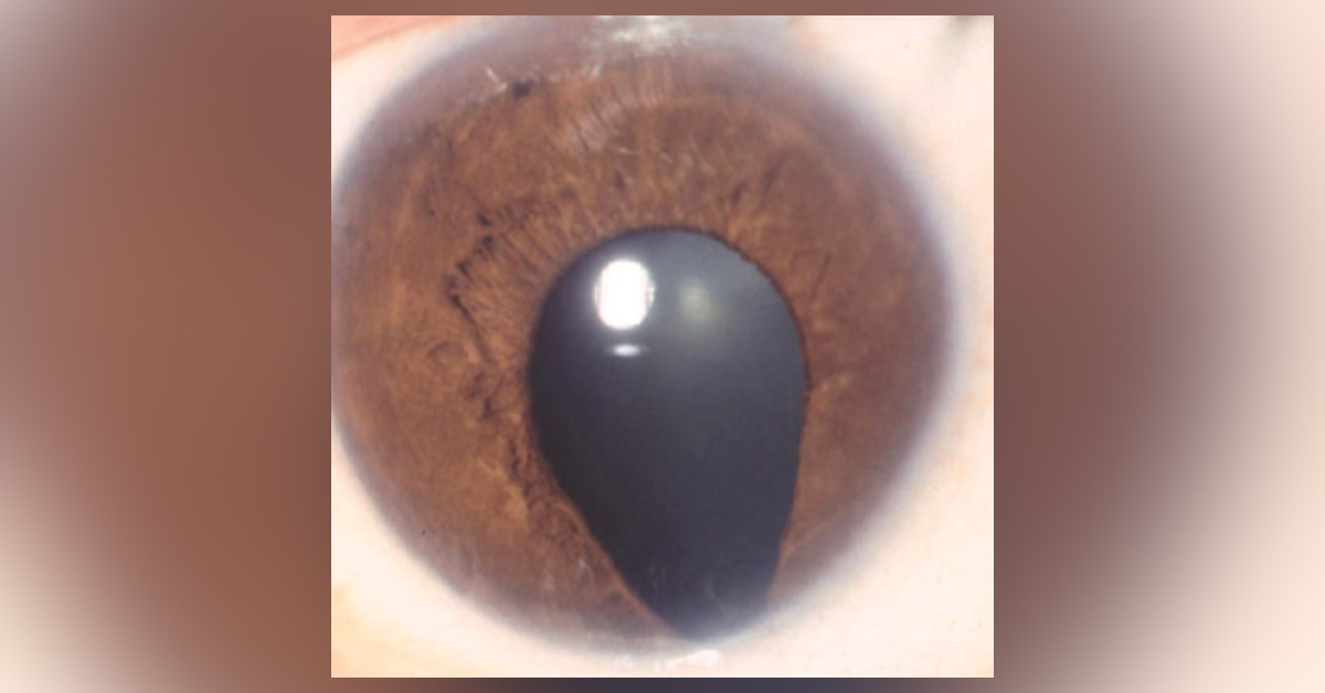 The Brief Scenario On Congenital Ophthalmic Conditions